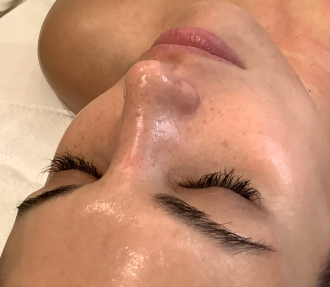 charlotte microdermabrasion